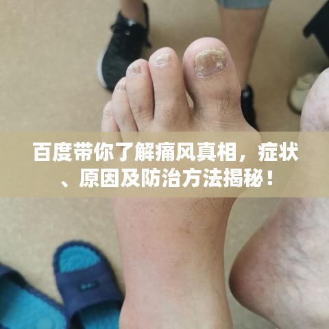 百度带你了解痛风真相，症状、原因及防治方法揭秘！