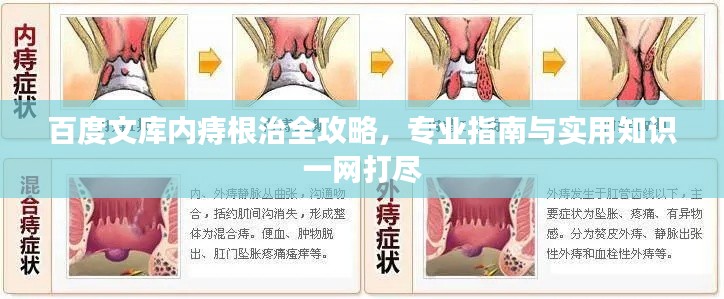 百度文库内痔根治全攻略，专业指南与实用知识一网打尽