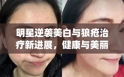 明星逆袭美白与狼疮治疗新进展,健康与美丽的双重追求