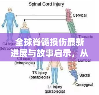 全球脊髓损伤最新进展与故事启示,从明星高分小说看康复之路